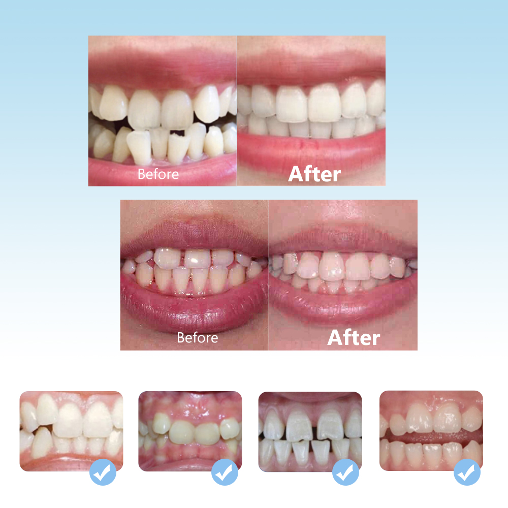 Tandheelkundige Orthodontische - Teeth Whitening Mouth Guard recensie en prijs