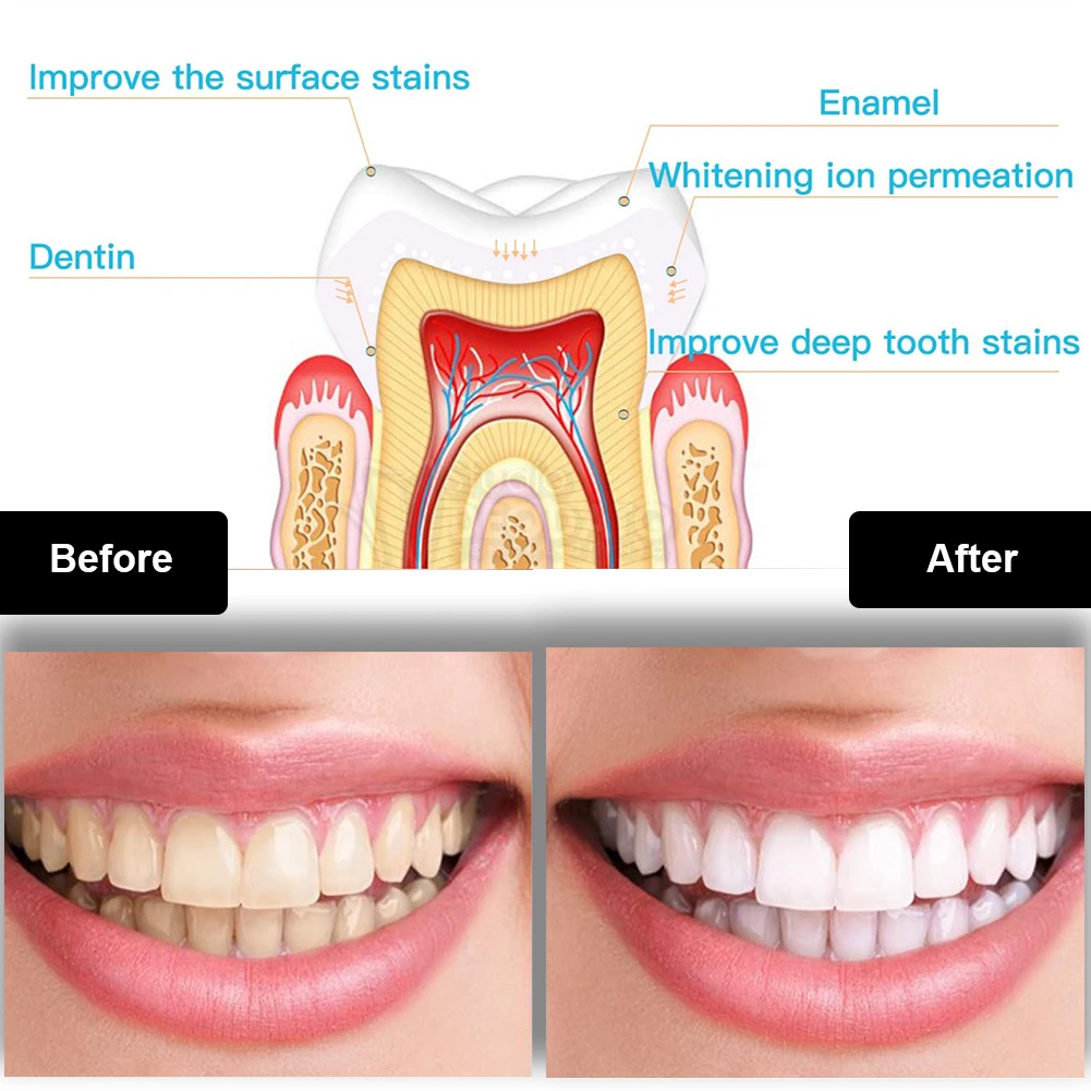 Tandheelkundige Tanden Whiteni - Teeth Whitening Trays recensie en prijs
