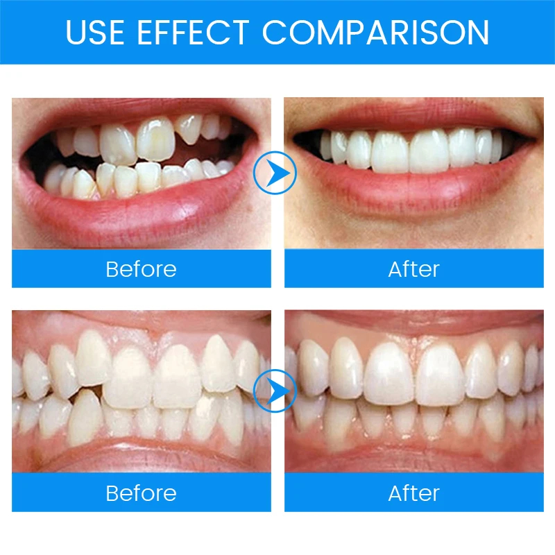 3 Fasen Tandheelkundige Orthod - Teeth Whitening Mouth Guard recensie en prijs